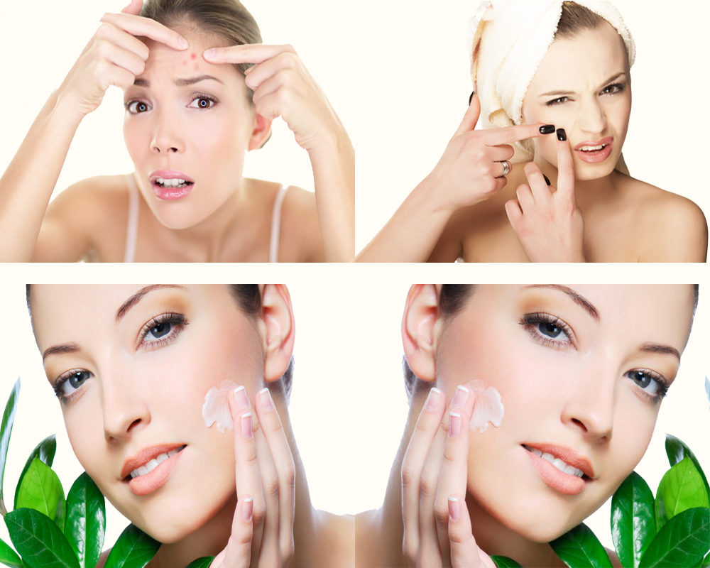 home remedies for acne