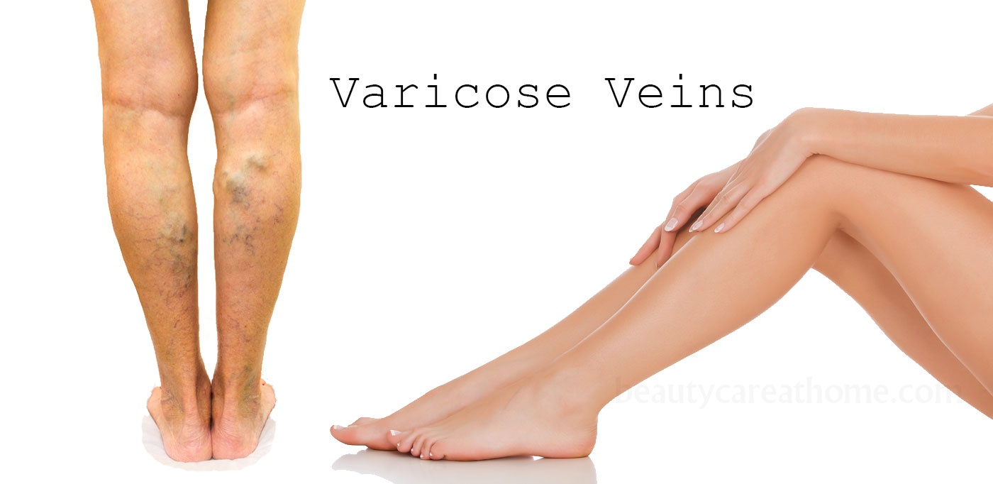 Treat Varicose Veins