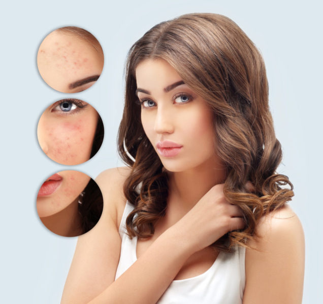 Treating Acne Scars